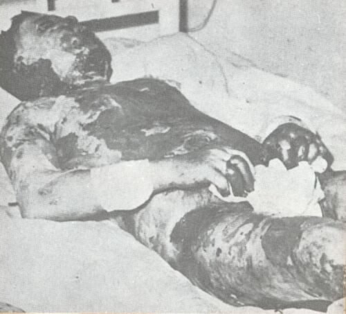 Greek Cypriot burned by the Turkish troops during the invasion of Cyprus.